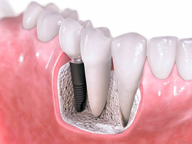 импланты зубов виды и цены