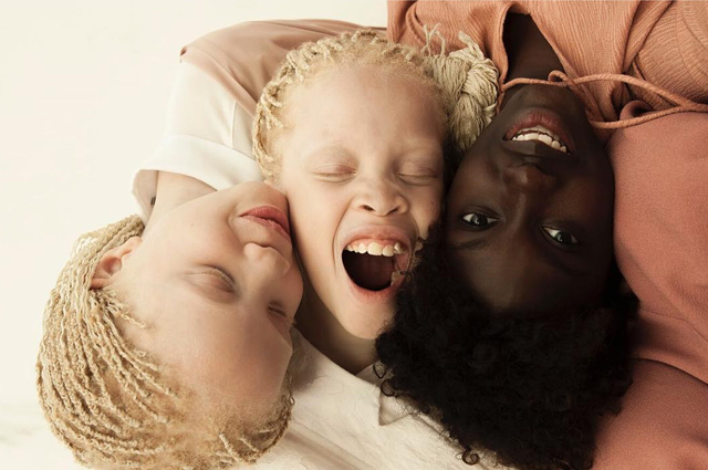 Сестры Бавар: как близнецы-альбиносы из Бразилии покоряют мир моды